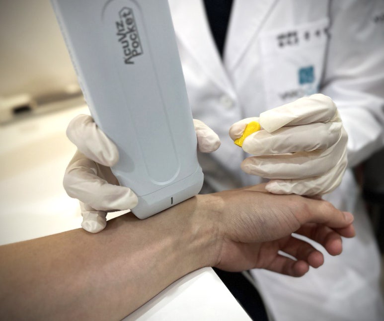 [경혈 초음파] 손목 통증, 드퀘르벵 건초염의 침 치료 효과 ‘입증’