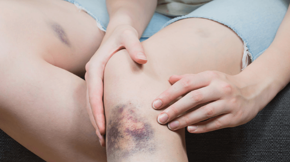 멍든 자리 혹<이것>일 수 있습니다. 타박상 어혈 도침 치료 멍 빼는 법