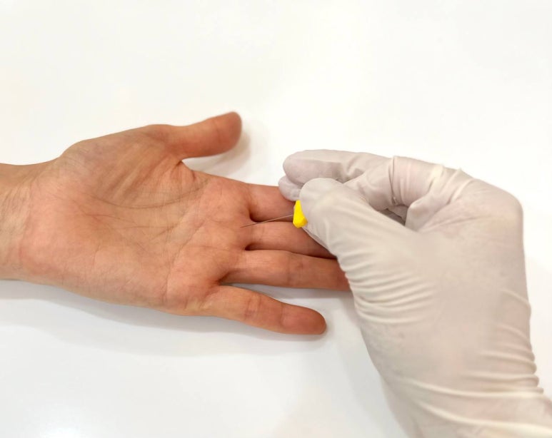 방아쇠 수지의 도침 치료, 경혈 초음파 활용시 효과 뛰어나