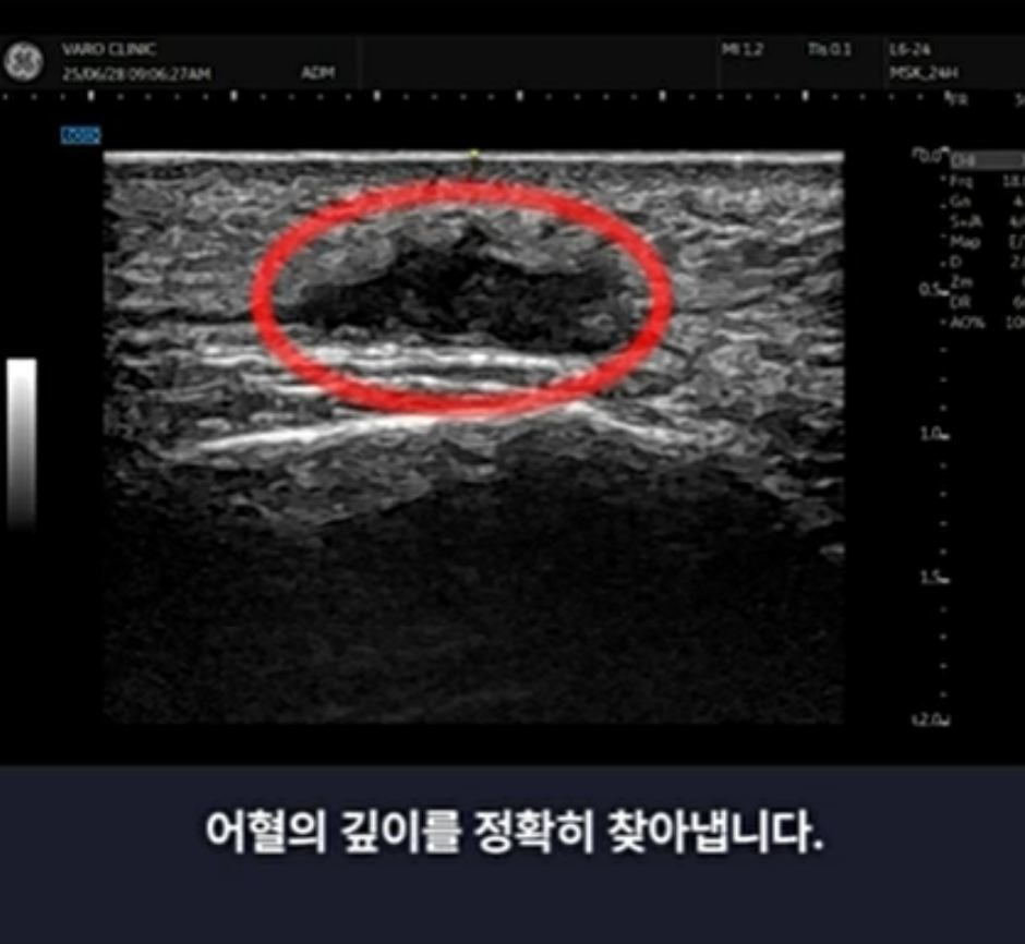 초음파 화면에 붉은 원으로 표시된 어둡고 불규칙한 형태의 혈종이 보인다 — 초음파 정밀 진단 | 서울 바로한의원 초음파 약침·도침·침도