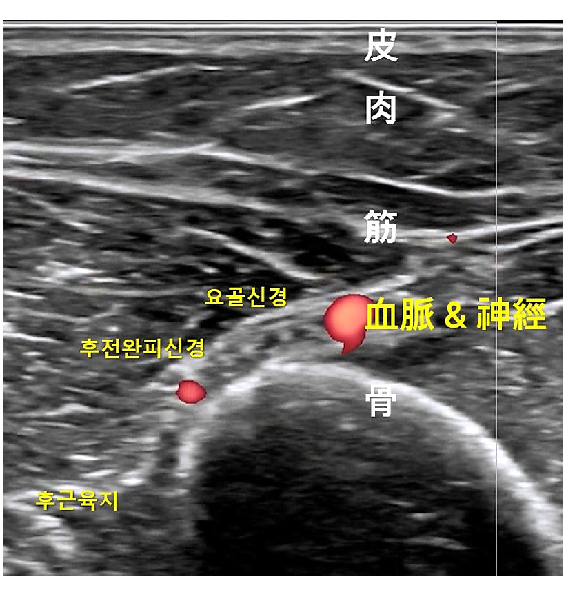 초음파 이미지에 피부, 근육, 뼈, 요골신경, 후전완피신경, 혈관 및 신경이 표시되어 있다 — 초음파 정밀 진단 | 서울 바로한의원 초음파 약침·도침·침도