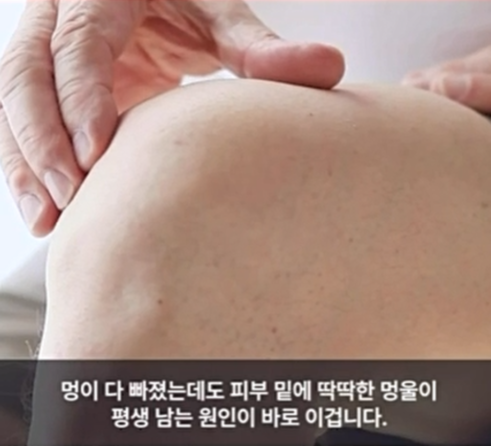 손으로 피부 아래 멍울을 누르는 모습 — 서울 바로한의원 초음파 약침·도침