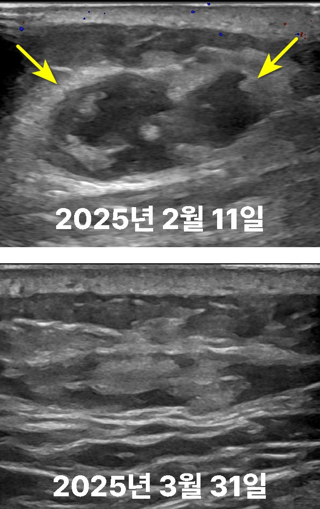 2025년 2월 11일과 3월 31일의 초음파 영상으로, 타박상으로 생긴 혈종이 점차 치유되는 모습입니다 — 초음파 정밀 진단 | 서울 바로한의원 초음파 약침·도침·침도