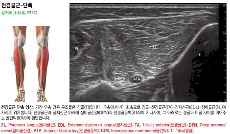 하퇴부 전면 근육의 해부학적 그림과 전경골근, 장지신근, 장비골근, 경골 등의 초음파 영상 — 초음파 정밀 진단 | 서울 바로한의원 초음파 약침·도침·침도
