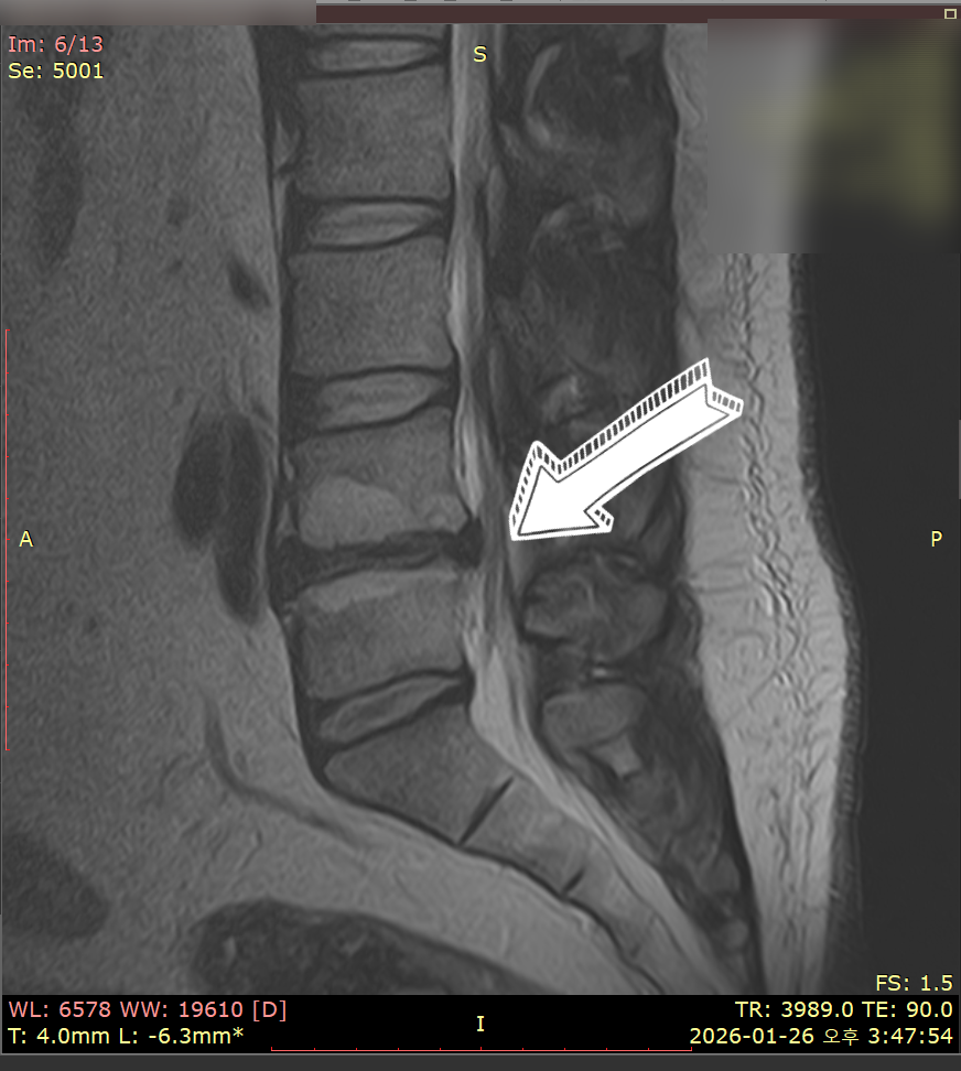 허리 MRI 사진에서 디스크 탈출증을 가리키는 화살표 — 서울 바로한의원 초음파 약침·도침