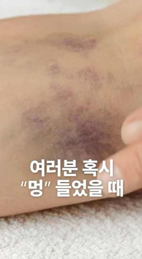피부에 여러 개의 보라색 멍이 든 모습 — 서울 바로한의원 초음파 약침·도침