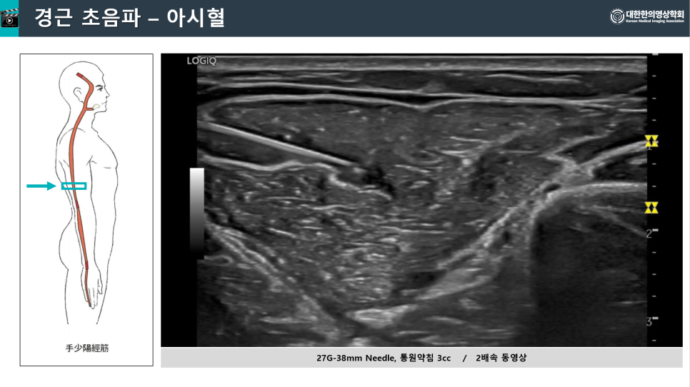 인체 측면도와 특정 부위를 가리키는 화살표, 그리고 근육에 침이 삽입된 초음파 영상 — 초음파 유도하 약침 시술 | 서울 바로한의원