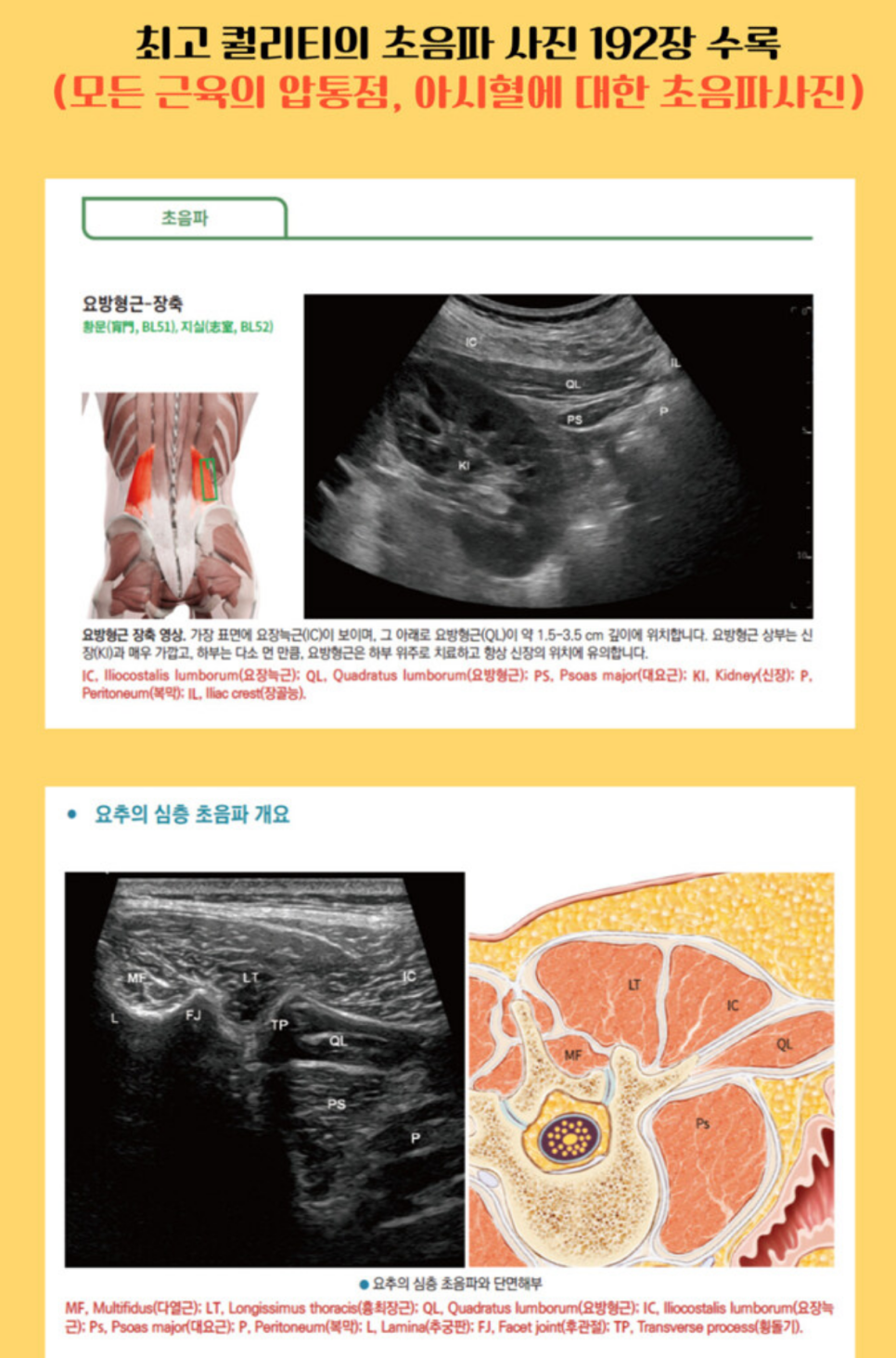 요방형근의 해부학적 그림과 초음파 영상, 요추 심층 근육의 해부학적 단면도와 초음파 영상이 나란히 있는 이미지 — 초음파 정밀 진단 | 서울 바로한의원 초음파 약침·도침·침도