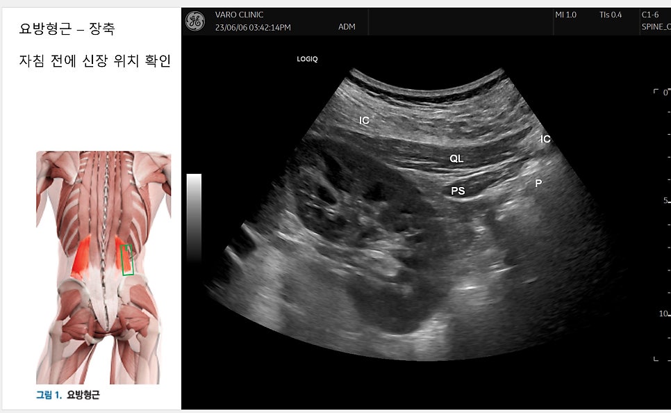 요방형근 해부도와 자침 전 신장 위치를 확인하는 요방형근 장축 초음파 영상 — 초음파 정밀 진단 | 서울 바로한의원 초음파 약침·도침·침도
