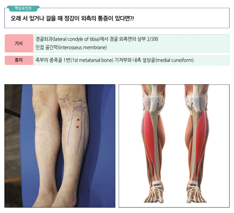 정강이 통증 치료를 위한 다리 해부학적 표시와 정강이 앞쪽 근육 해부도 — 서울 바로한의원 초음파 약침·도침