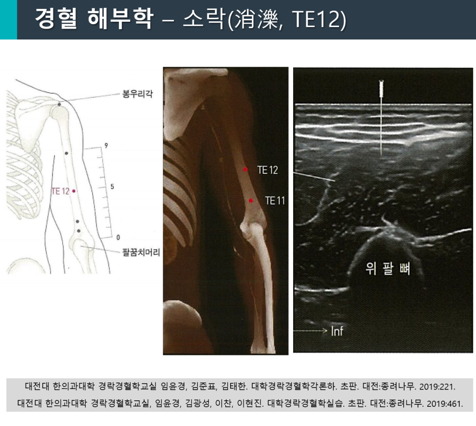 팔의 경혈점 TE12의 해부학적 위치를 보여주는 그림, 엑스레이 이미지, 그리고 침 시술이 보이는 초음파 사진 — 초음파 유도하 약침 시술 | 서울 바로한의원