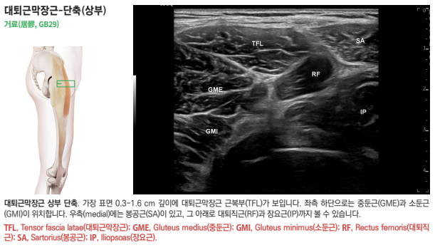 대퇴근막장근 상부의 해부학적 위치를 보여주는 인체 그림과 주변 근육이 표시된 초음파 영상 — 초음파 정밀 진단 | 서울 바로한의원 초음파 약침·도침·침도