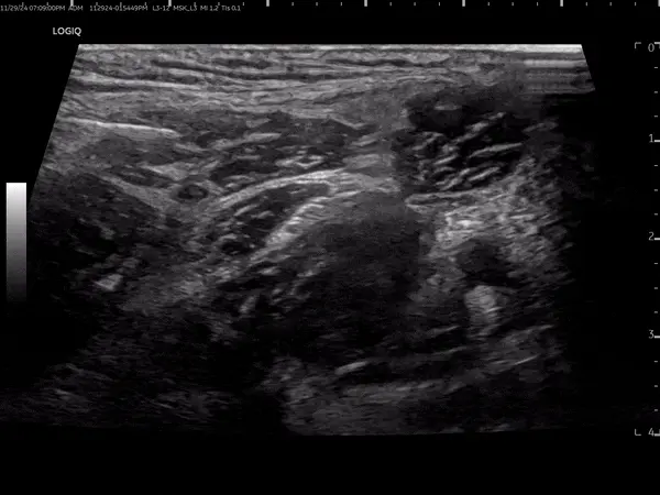 대퇴부 장경인대 부위의 초음파 사진 — 초음파 정밀 진단 | 서울 바로한의원 초음파 약침·도침·침도