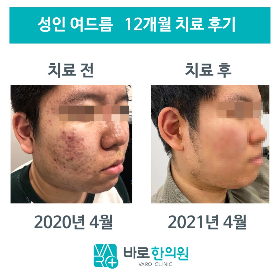 12개월 한약 치료 전 여드름이 많던 얼굴과 치료 후 개선된 얼굴을 비교한 사진 — 서울 바로한의원 초음파 약침·도침