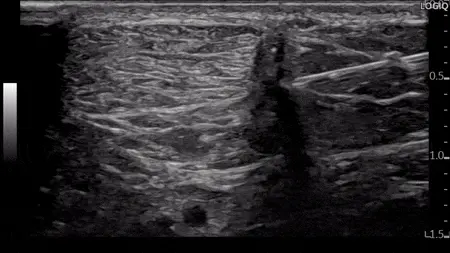 초음파 영상에서 아킬레스건에 삽입된 주사 바늘 — 초음파 유도하 약침 시술 | 서울 바로한의원