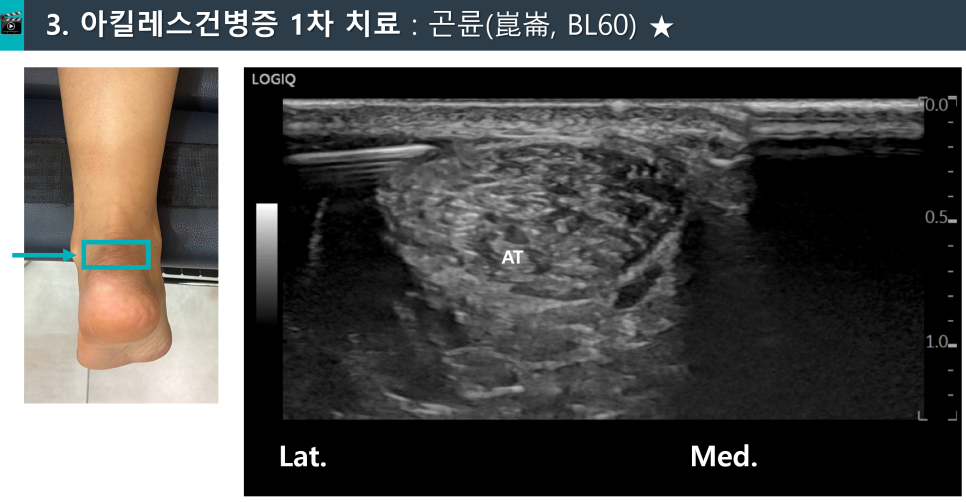 환자의 발목과 아킬레스건 초음파 사진 — 초음파 정밀 진단 | 서울 바로한의원 초음파 약침·도침·침도