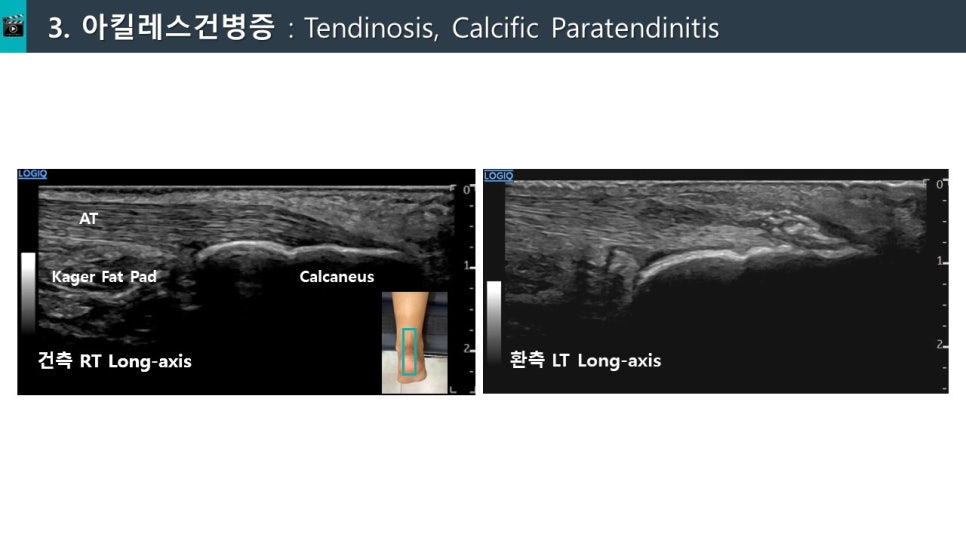 아킬레스건병증 초음파 사진으로, 건측과 환측의 종축 영상을 비교하여 보여준다 — 초음파 정밀 진단 | 서울 바로한의원 초음파 약침·도침·침도