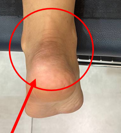 발목 뒤쪽과 발뒤꿈치 부위를 빨간 원과 화살표로 표시한 사진 — 서울 바로한의원 초음파 약침·도침