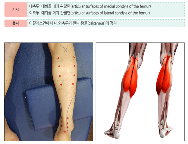 아킬레스건 관련 설명과 함께 다리에 표시된 붉은 점들, 그리고 종아리 근육 해부도 — 서울 바로한의원 초음파 약침·도침