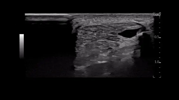 초음파로 촬영한 연부 조직 사진으로, 내부에 물혹이 보인다 — 초음파 정밀 진단 | 서울 바로한의원 초음파 약침·도침·침도