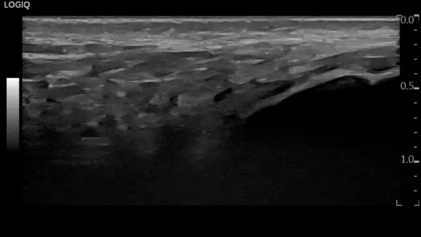 아킬레스건 주변에 보이는 물혹 초음파 사진 — 초음파 정밀 진단 | 서울 바로한의원 초음파 약침·도침·침도