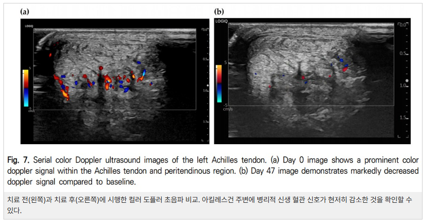 아킬레스건의 컬러 도플러 초음파 이미지로, 치료 전(왼쪽)과 치료 후(오른쪽)의 혈류 신호 변화를 보여준다 — 초음파 정밀 진단 | 서울 바로한의원 초음파 약침·도침·침도