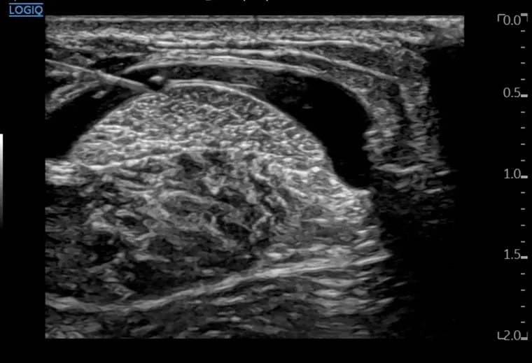 아킬레스건 주변의 염증 또는 액체 저류를 나타내는 초음파 사진 — 초음파 정밀 진단 | 서울 바로한의원 초음파 약침·도침·침도