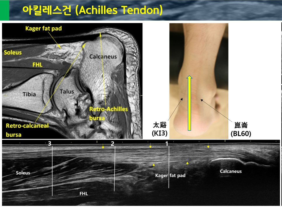 아킬레스건의 MRI, 초음파 영상과 발뒤꿈치 혈자리 사진을 함께 보여주는 이미지 — 초음파 정밀 진단 | 서울 바로한의원 초음파 약침·도침·침도