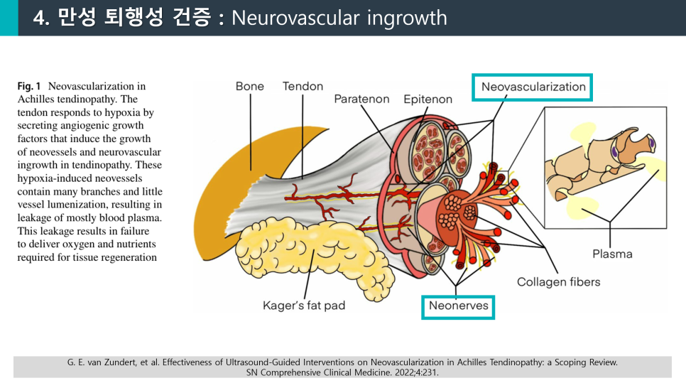 아킬레스건의 해부학적 구조와 신생혈관, 신생신경 증식을 보여주는 도해 — 서울 바로한의원 초음파 약침·도침