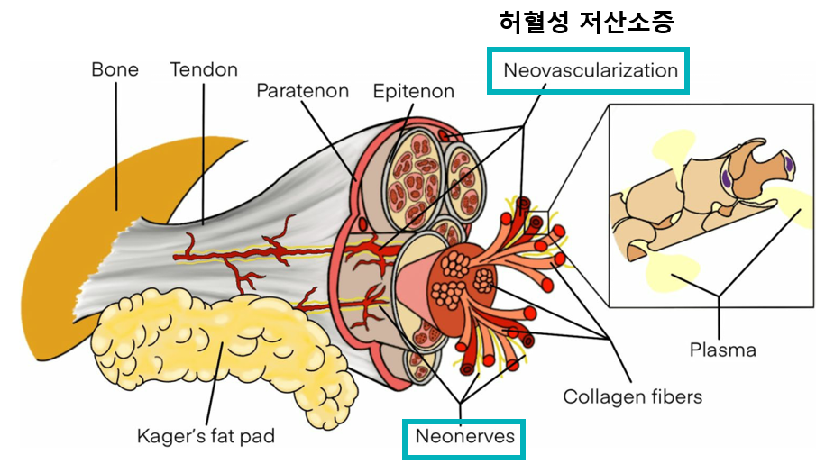 힘줄의 해부학적 구조와 허혈성 저산소증으로 인한 신생혈관, 신생신경을 보여주는 다이어그램입니다 — 서울 바로한의원 초음파 약침·도침