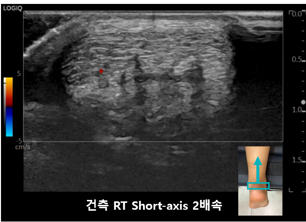 아킬레스건의 초음파 사진으로, 붉은 점과 함께 발목 부위의 스캔 위치를 나타내는 작은 이미지가 보인다 — 초음파 정밀 진단 | 서울 바로한의원 초음파 약침·도침·침도