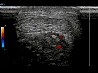 아킬레스건 부위의 초음파 영상으로, 혈류 신호가 나타나 있다 — 초음파 정밀 진단 | 서울 바로한의원 초음파 약침·도침·침도