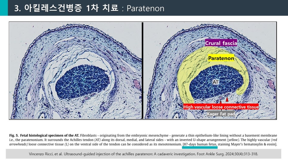 아킬레스건과 주변 조직의 태아 조직학적 표본 이미지. 오른쪽 이미지는 파라테논이 노란색으로 표시되어 있다 — 서울 바로한의원 초음파 약침·도침