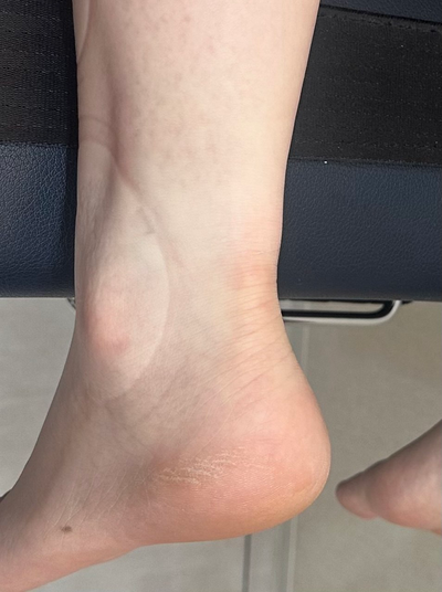 발목 뒤쪽 아킬레스건 부위에 부기가 있는 모습 — 서울 바로한의원 초음파 약침·도침