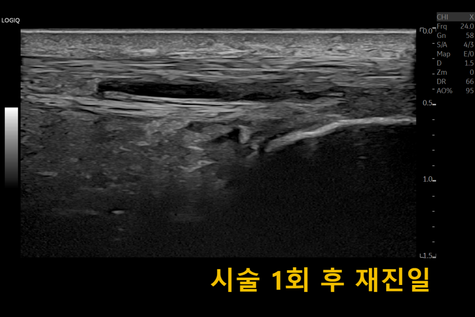 아킬레스건 부위 초음파 사진, 시술 1회 후 물혹 관찰 — 초음파 유도하 약침 시술 | 서울 바로한의원