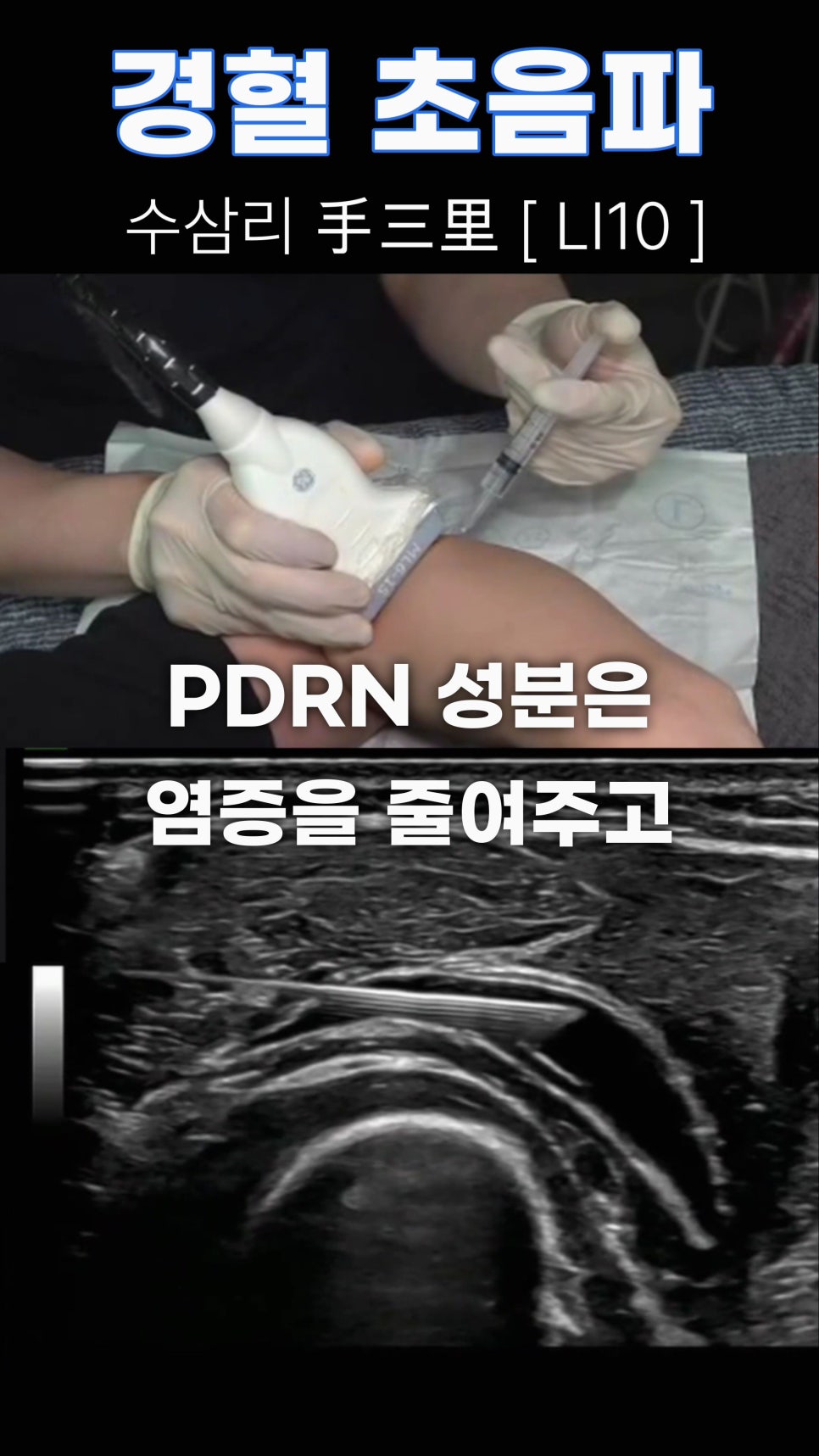 초음파 기기로 팔 부위의 수삼리(LI10) 경혈에 약물을 주입하는 모습과 주입 중인 바늘이 보이는 초음파 화면 — 초음파 유도하 약침 시술 | 서울 바로한의원