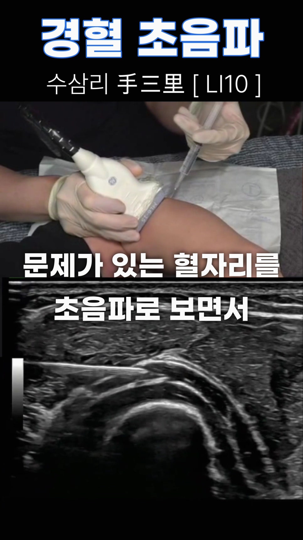 환자의 팔에 초음파 탐촉자를 대고 약물을 주입하는 모습과 주사 바늘이 보이는 초음파 영상 — 초음파 유도하 약침 시술 | 서울 바로한의원