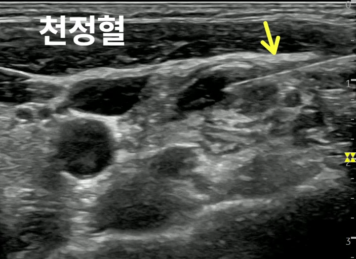 초음파 영상에서 천정혈 부위에 삽입된 침이 노란색 화살표로 표시되어 있습니다 — 초음파 유도하 약침 시술 | 서울 바로한의원