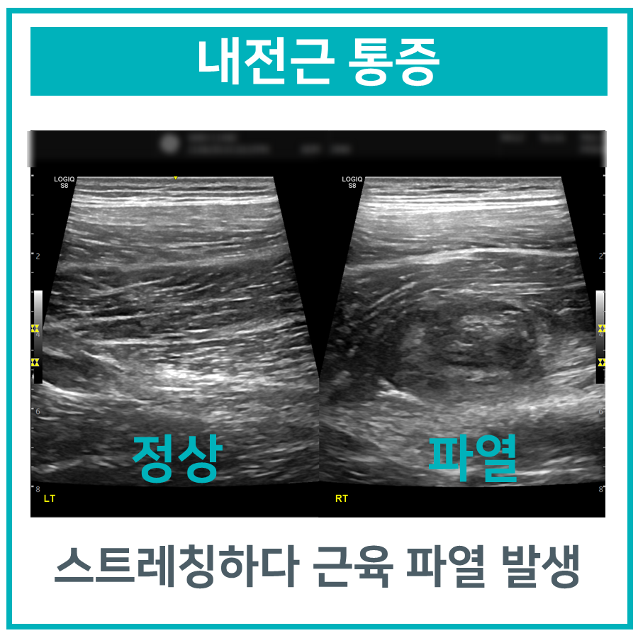 정상 내전근과 파열된 내전근을 비교하는 초음파 사진 — 초음파 정밀 진단 | 서울 바로한의원 초음파 약침·도침·침도