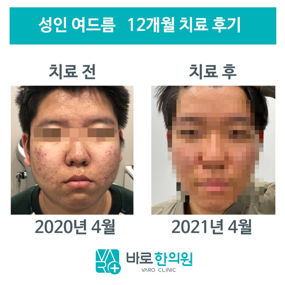 2020년 4월 여드름이 있는 얼굴과 2021년 4월 여드름이 개선된 얼굴을 나란히 보여주는 사진 — 서울 바로한의원 초음파 약침·도침