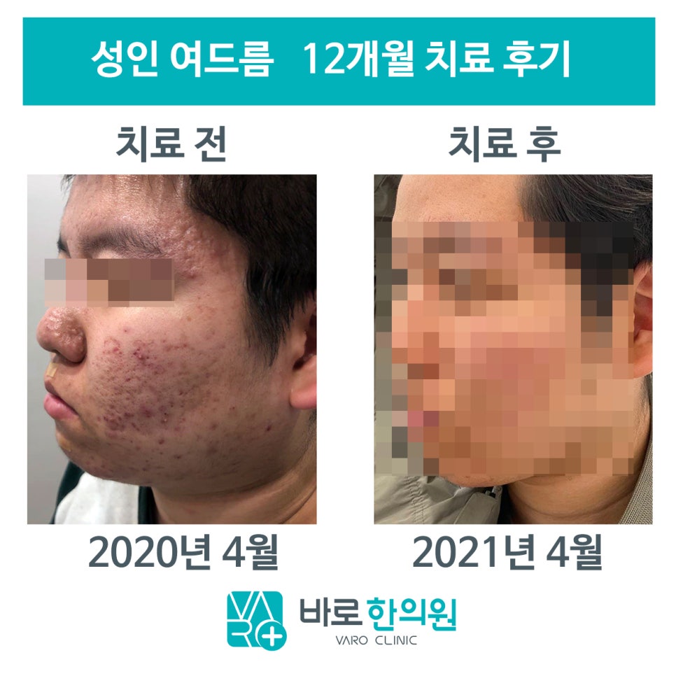 성인 여드름 12개월 치료 전후 사진. 치료 전 얼굴에는 여드름과 붉은 자국이 많고, 치료 후 얼굴은 여드름과 붉은 자국이 줄어든 모습이다 — 서울 바로한의원 초음파 약침·도침