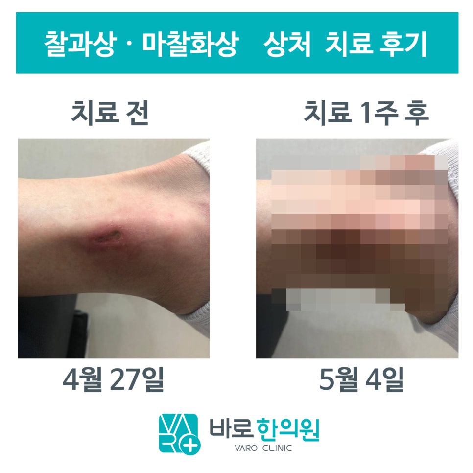 발목에 생긴 찰과상 치료 전과 1주 후의 모습 — 서울 바로한의원 초음파 약침·도침