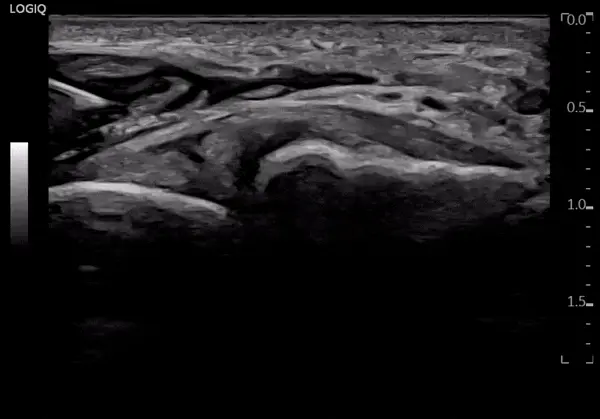 발목 위쪽 통증? 전하 경비인대 결합, 골간인대 파열 비수술치료법 <확인>