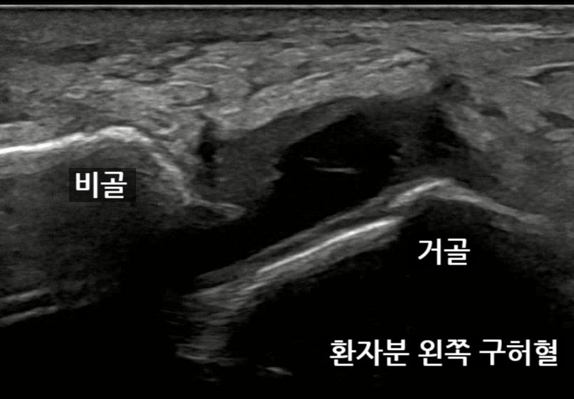 발목 초음파 사진으로, 비골과 거골 사이의 인대 파열이 보이는 모습 — 초음파 정밀 진단 | 서울 바로한의원 초음파 약침·도침·침도