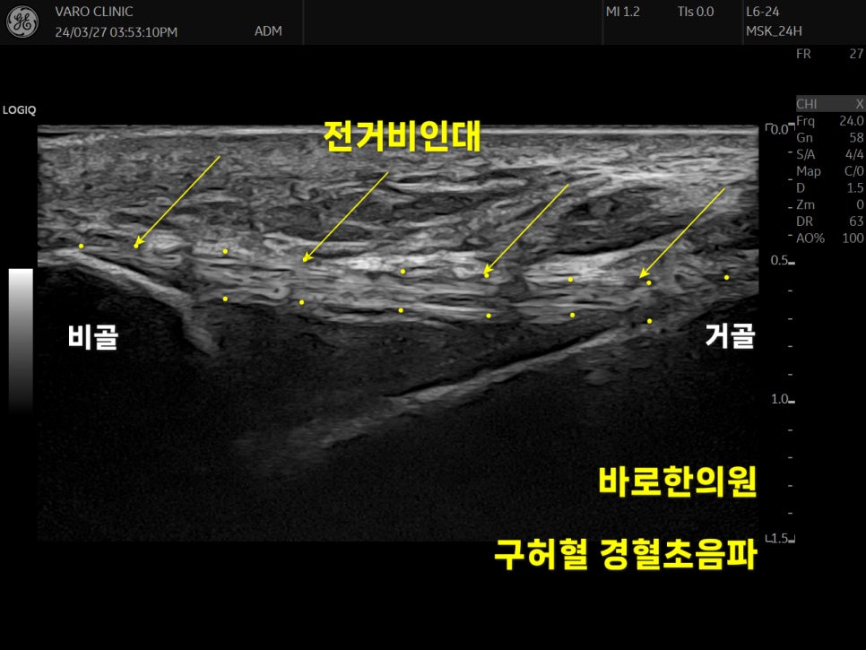 발목 전거비인대 초음파 사진으로, 비골과 거골 사이의 인대를 노란색 화살표로 표시한 모습 — 초음파 정밀 진단 | 서울 바로한의원 초음파 약침·도침·침도