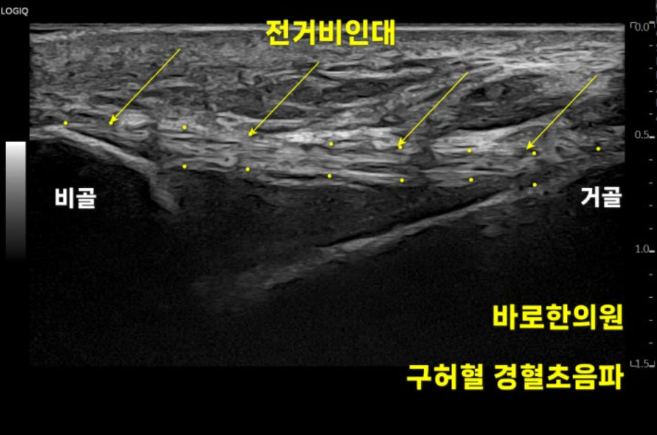 발목 전거비인대 초음파 사진으로, 비골과 거골 사이에 있는 인대를 보여줍니다 — 초음파 정밀 진단 | 서울 바로한의원 초음파 약침·도침·침도