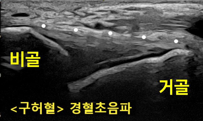 발목 앞쪽 초음파 사진으로 비골과 거골, 전거비인대가 보이며, '구허혈 경혈초음파'라는 문구가 있다 — 초음파 정밀 진단 | 서울 바로한의원 초음파 약침·도침·침도