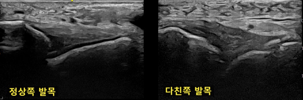 정상 발목과 다친 발목의 초음파 비교 영상 — 초음파 정밀 진단 | 서울 바로한의원 초음파 약침·도침·침도