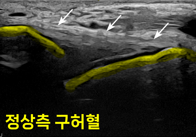 발목 부위의 초음파 사진으로, 노란색으로 표시된 인대와 화살표로 가리킨 주변 조직이 보인다. 화면 하단에 '정상측 구허혈'이라는 글자가 있다 — 초음파 정밀 진단 | 서울 바로한의원 초음파 약침·도침·침도