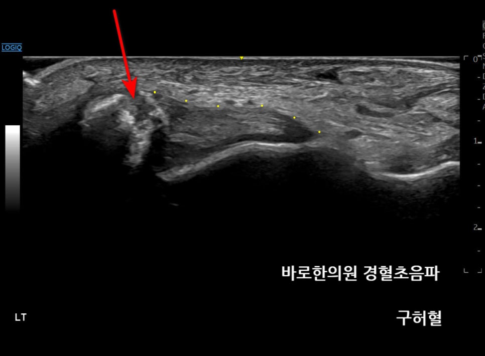 발목 부위의 초음파 사진으로, 뼈의 불규칙한 부분이 빨간색 화살표로 표시되어 있습니다 — 초음파 정밀 진단 | 서울 바로한의원 초음파 약침·도침·침도
